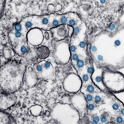 Transmission electron microscopic image of an isolate from the first U.S. case of COVID-19. The spherical viral particles, colorized blue, contain cross-sections through the viral genome, seen as black dots.